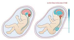 Cách ngăn ngừa dị tật ống thần kinh ở thai nhi mẹ bầu cần lưu ý